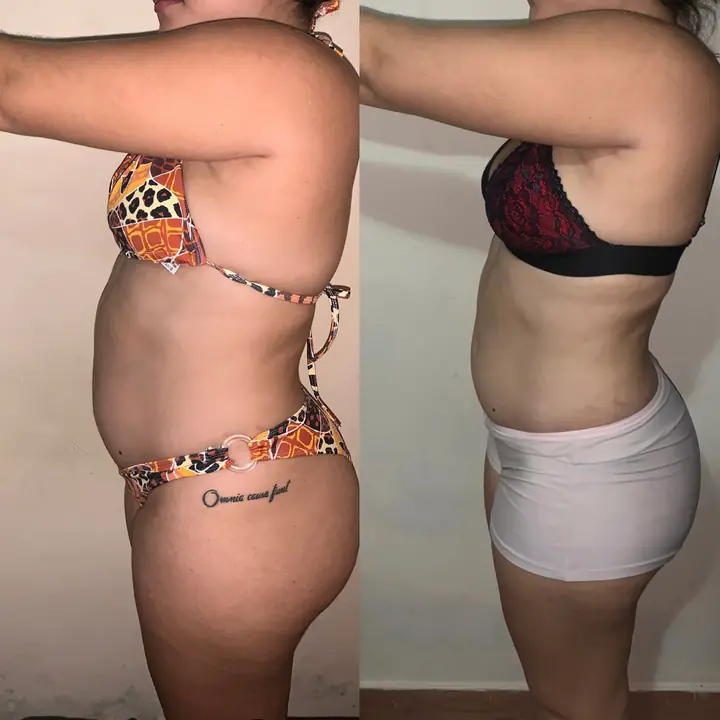 Antes e depois de uma participante fotografada de perfil, mostrando a mudança na silhueta.